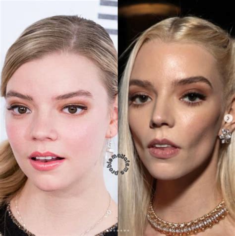 anya taylor joy before and after surgery.